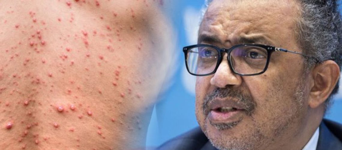 La OMS declara la viruela del mono como emergencia sanitaria internacional